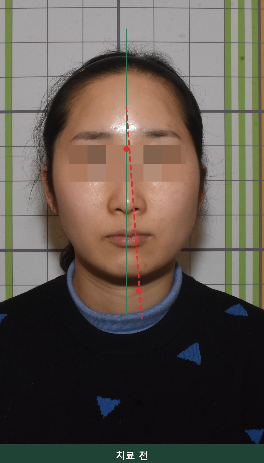 안면비대칭 교정 치료 전 정면 사진. 미간을 지나는 기준 중심선(초록 실선)에서 턱끝이 오른쪽으로 벗어나 실제 안면 축(빨간 점선)이 기울어져 있음