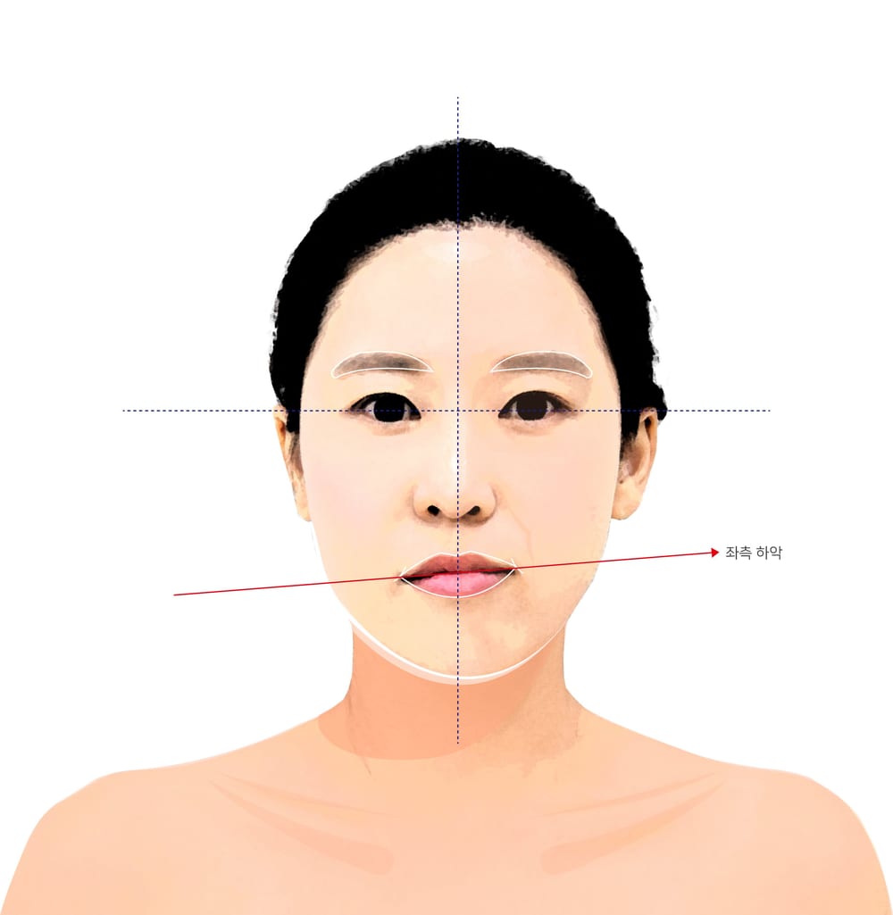 정면 얼굴에 세로 중심선과 눈높이·입꼬리 가로선을 그어 안면비대칭을 확인하는 방법
