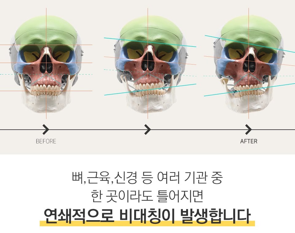 두개골 모형으로 본 안면비대칭 진행 과정 — 한 곳의 틀어짐이 눈높이, 교합면 기울기로 이어지는 모습