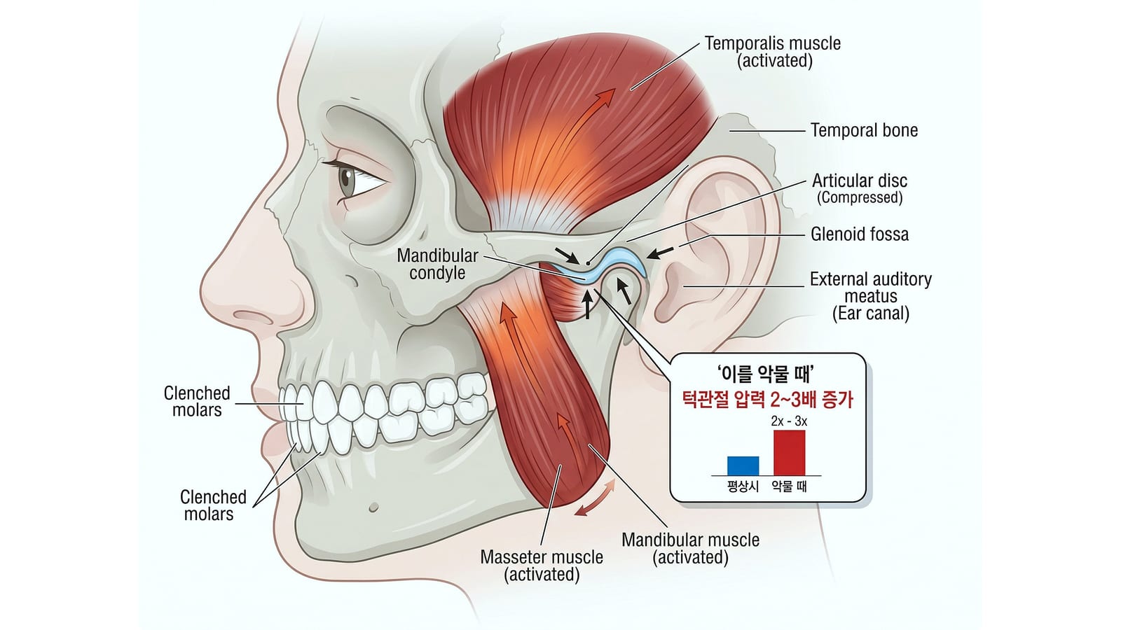 턱관절과 측두근·교근의 구조 — 이를 악물 때 턱관절에 가해지는 압력이 증가하는 모습을 나타낸 해부도
